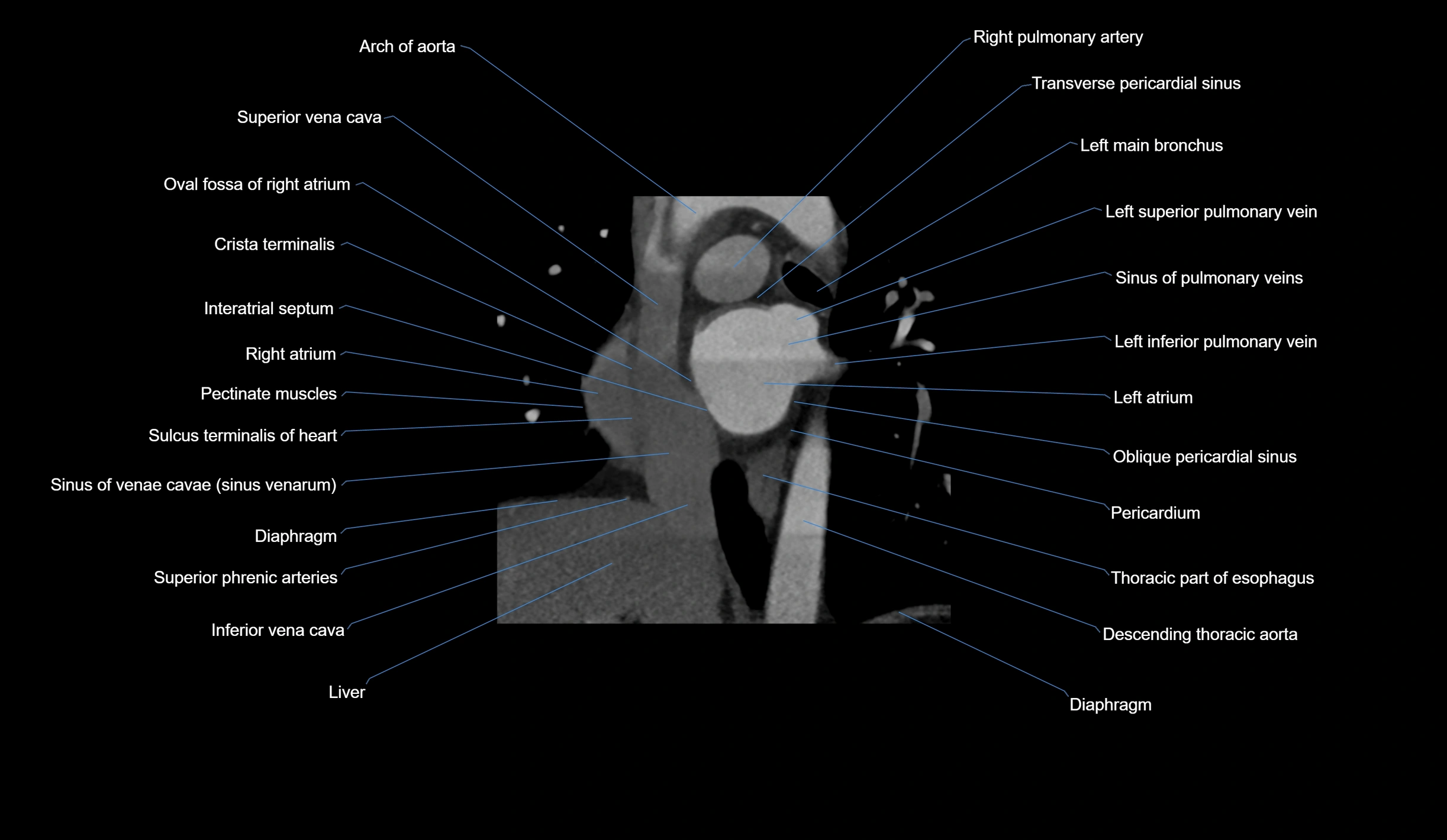 CT heart (coronary angiogram) short axis view  cross sectional anatomy labelled radiology image-00012.webp